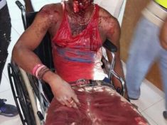 Nigerian mans face torn by mobile phone explosion