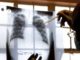 Extensively Drug Resistant TB on the Rise in South Africa