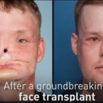 56 hour groundbreaking face transplant surgery gives man a new face
