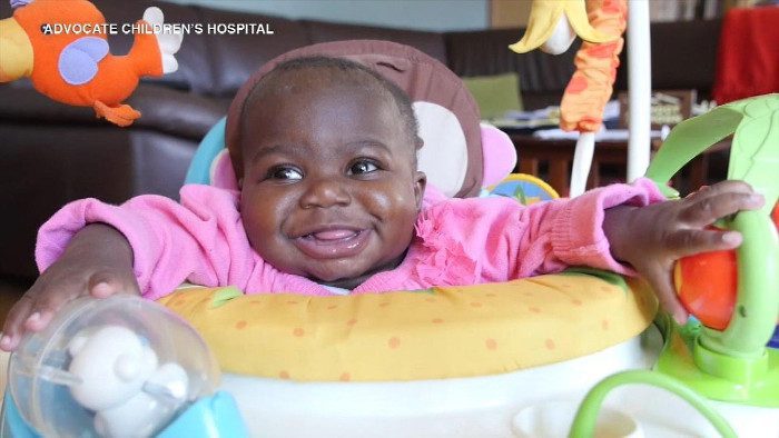 Girl born with 4 legs 2 spines seperated