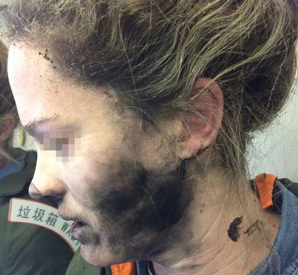 Headphone battery explosion victim