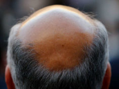 Risk of Premature Balding Found in Genes of Short Men
