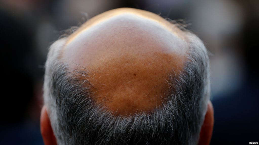 Risk of Premature Balding Found in Genes of Short Men