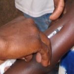 injection