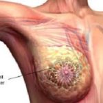 breast cancer
