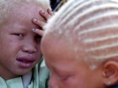 UN Resettles Albino Refugees Due to Threats in Malawi
