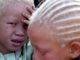 UN Resettles Albino Refugees Due to Threats in Malawi