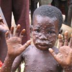 6068749 monkeypox jpeg2db124b9f59b6df6d4e55e0733d39042