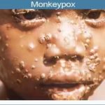 monkeypox