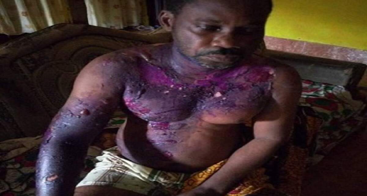 Woman Pours Boiling Water On Sleeping Husband In Bayelsa