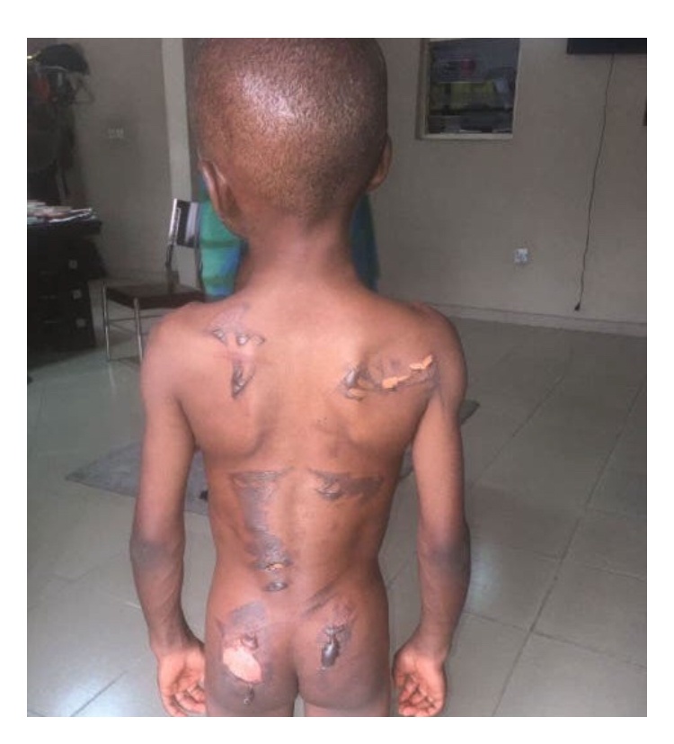 SAD- Woman Burns 8-Year-Old Boy With Iron For Eating Her N50 Groundnut