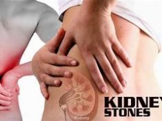 CBD OIL REMEDIES FOR KIDNEY STONES 2