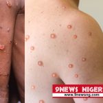 World Health Organization WHO Declares Another Global Health Emergency As Monkeypox Spreads