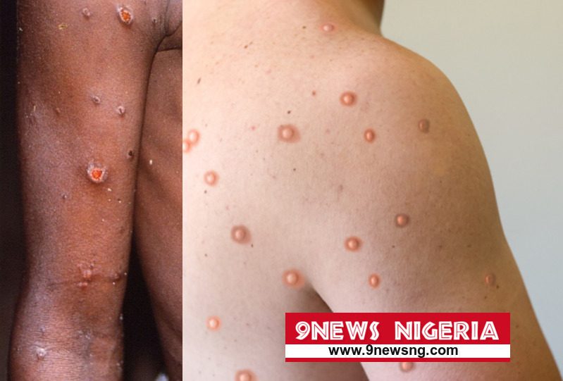 World Health Organization WHO Declares Another Global Health Emergency As Monkeypox Spreads